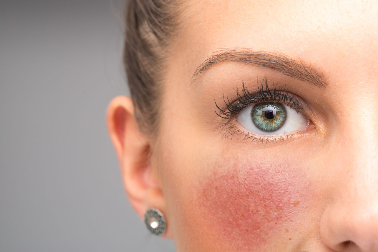 Red flushing cheeks are seen closeup, in the face of a stunning thirty something caucasian girl, permanent redness and small visible blood vessels, symptoms of rosacea with room for copy.,Red flushing cheeks are seen closeup, in the face of a stunning 