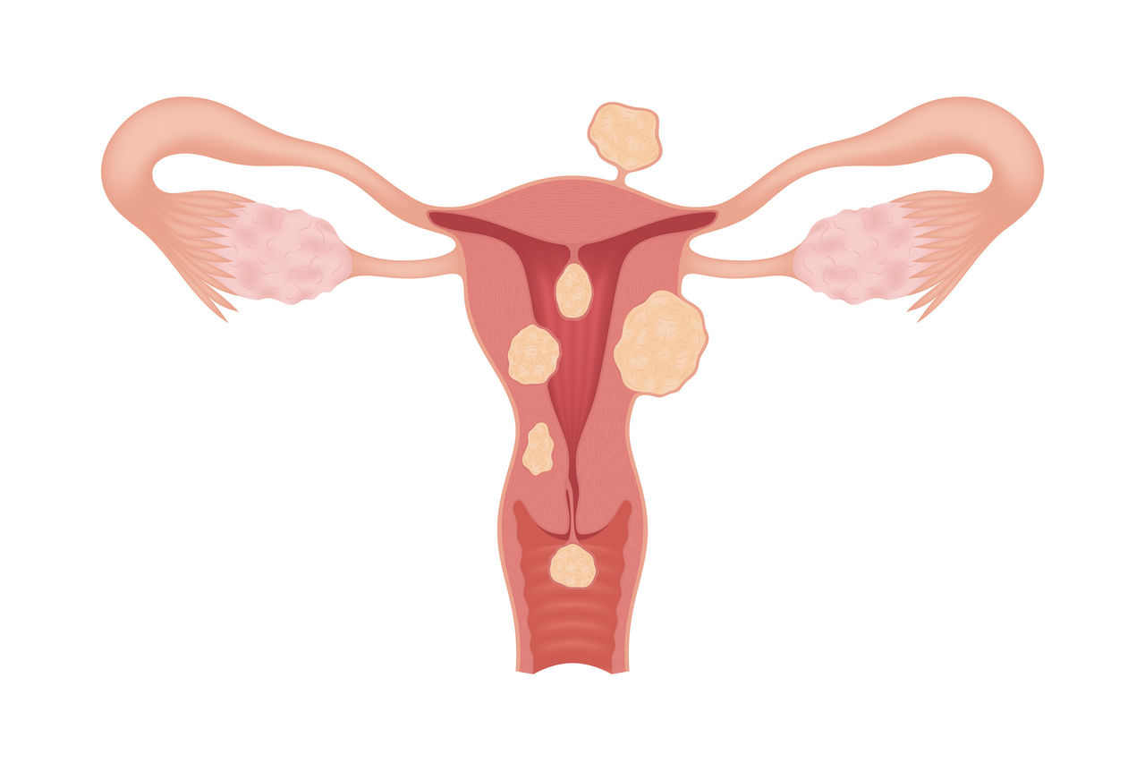 Sick female reproductive system with various types of myomas isolated on whte background. Realistic drawing showing the internal organs. Frontal view in a cut.,Sick female reproductive system with various types of myomas iso