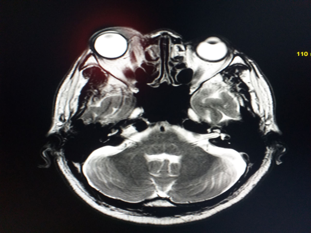 MRI Brain and Orbits Showing mass.