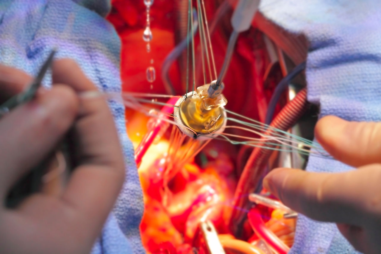 artificial heart valve in the implantation process.