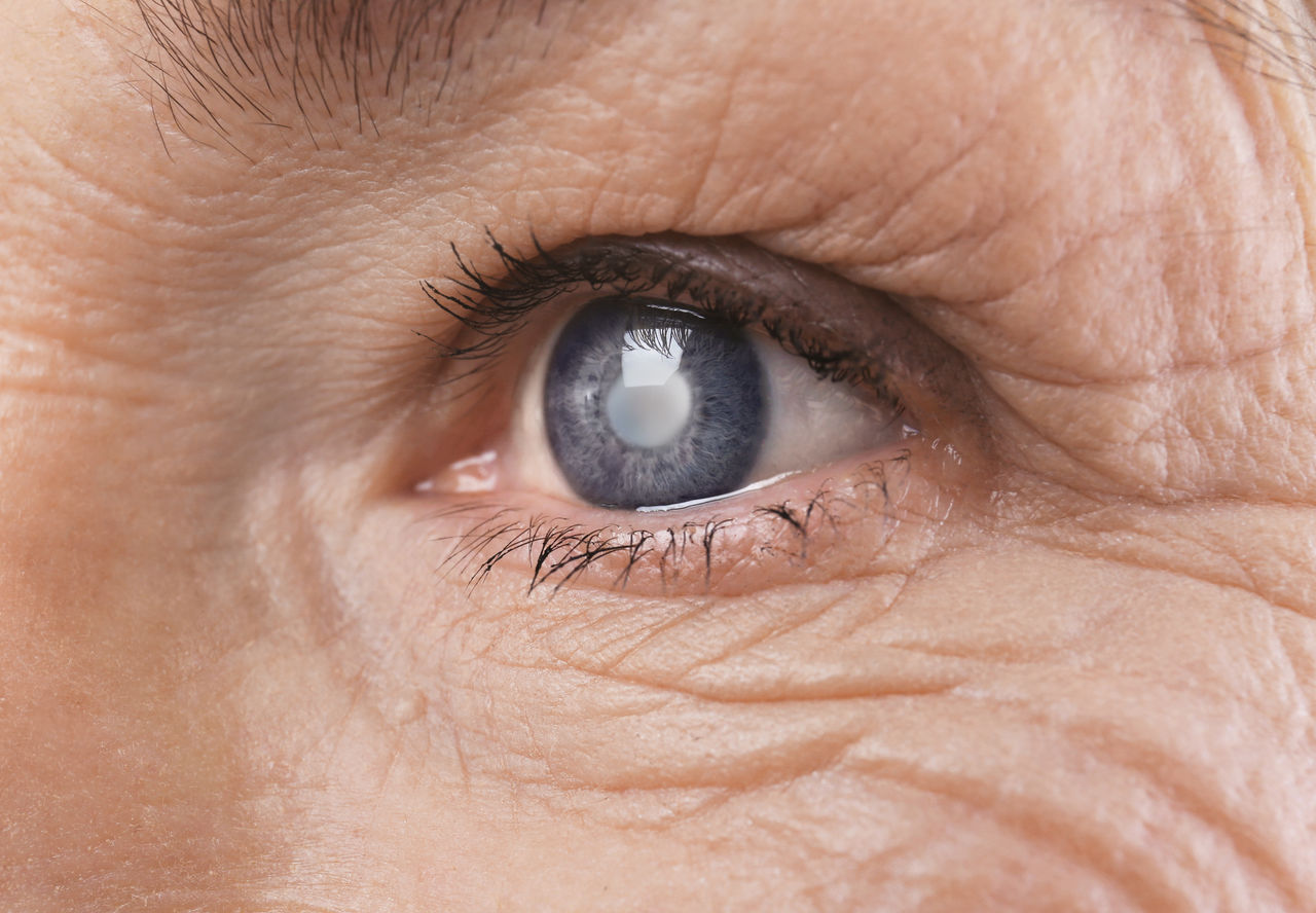 Grauer Star-Operation: Wenn die Augenlinse eintrübt