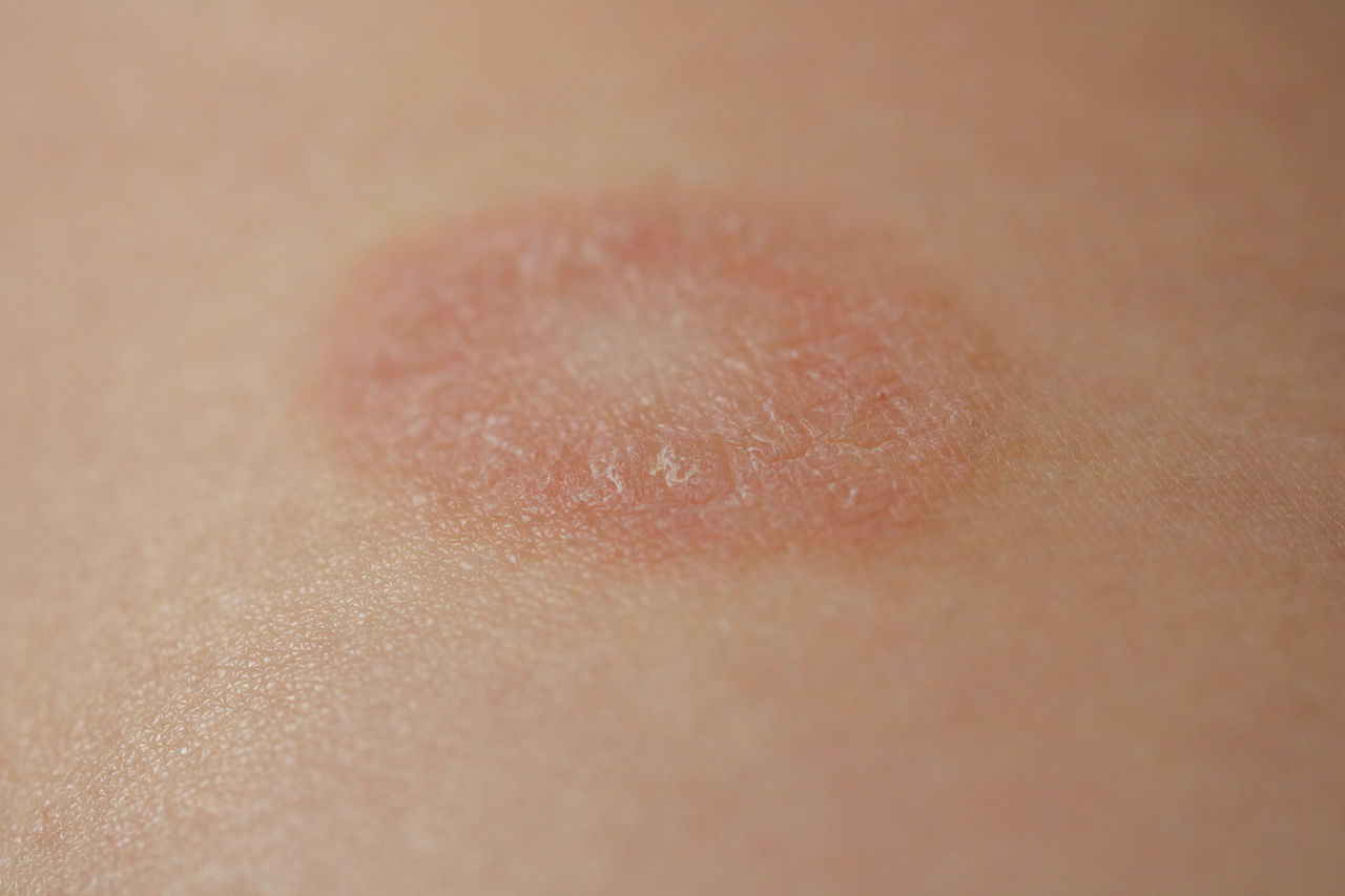 Röschenflechte: unschöne Hautrötungen bei Pityriasis rosea