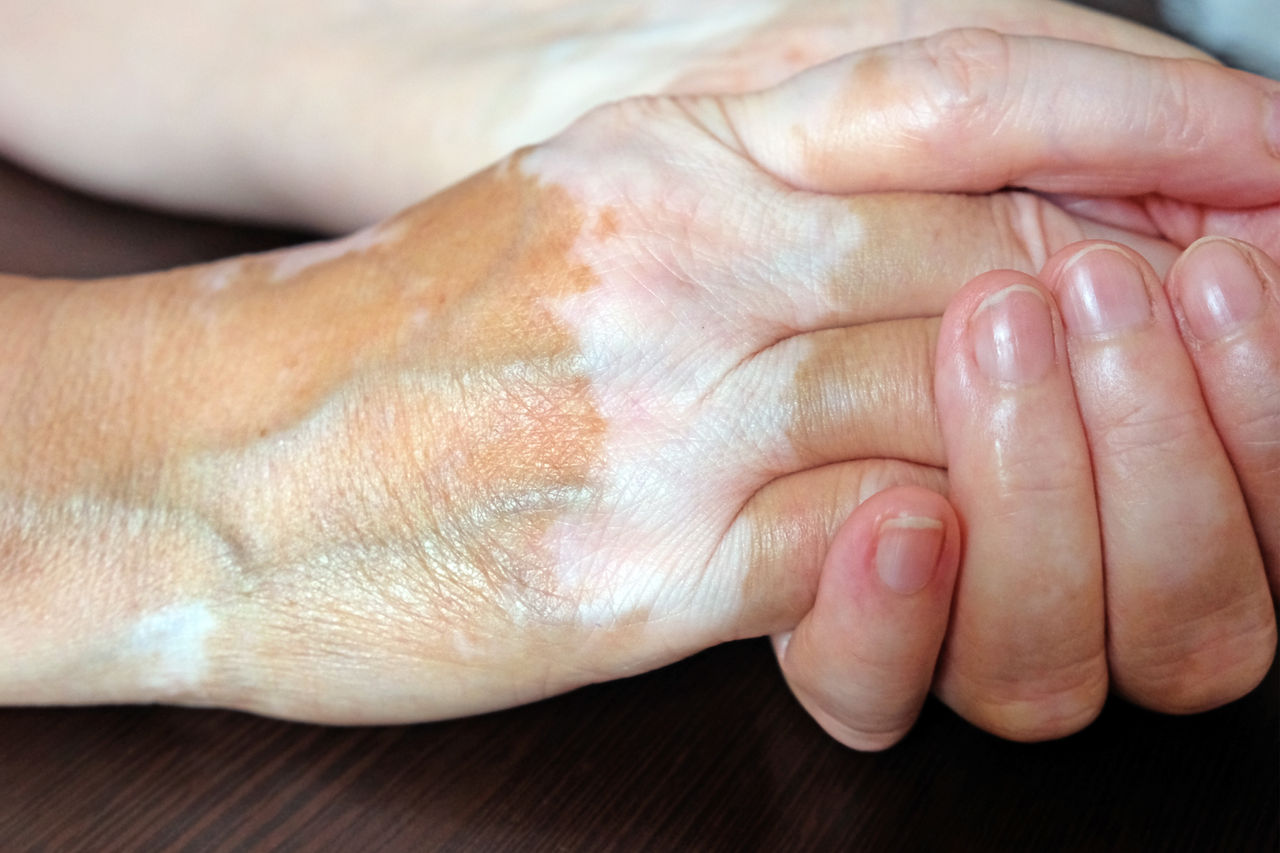 Vitiligo: Was steckt hinter der Weißfleckenkrankheit?