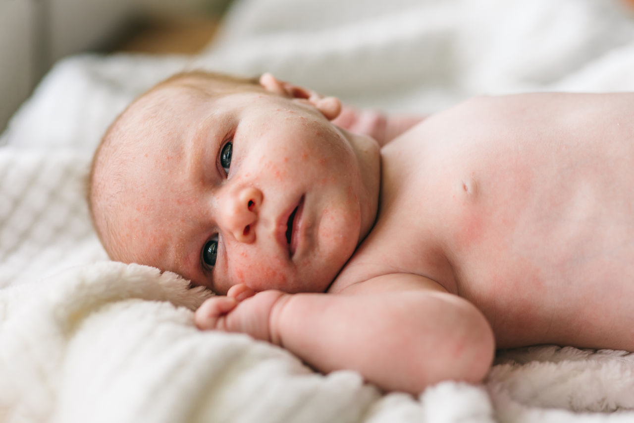 Baby acne, small red and purulent inflammations on the skin of the face of a one-month-old baby. How to distinguish from atopic dermatitis, allergies,Baby acne, small red and purulent inflammations on the skin of t
