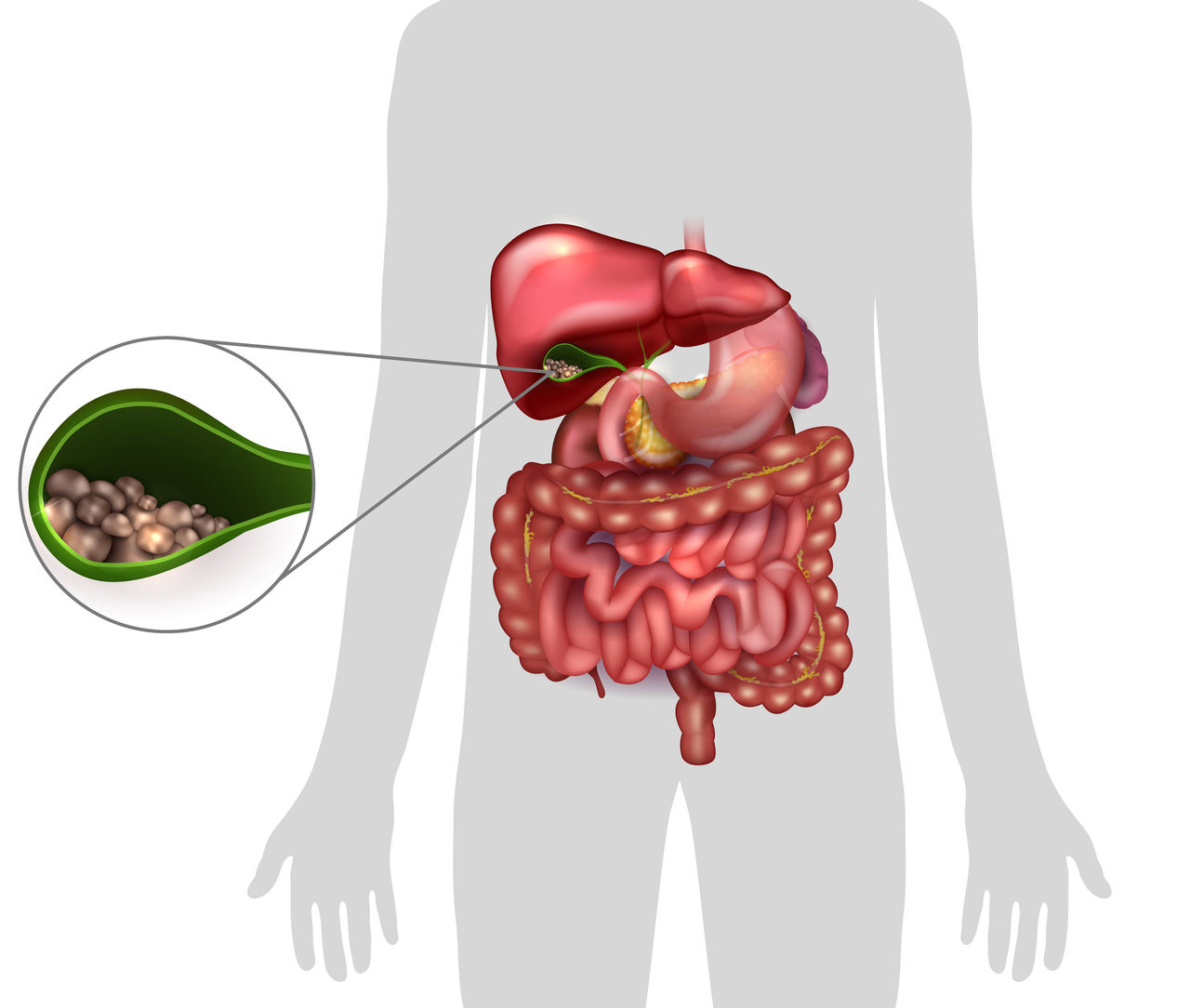 Gallstones in the Gallbladder, human silhouette and anatomy of surrounding organs.,Gallstones in the Gallbladder, human silhouette and anatomy of s