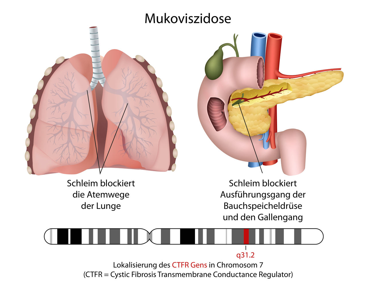 Mukoviszidose – zäher Schleim im Körper
