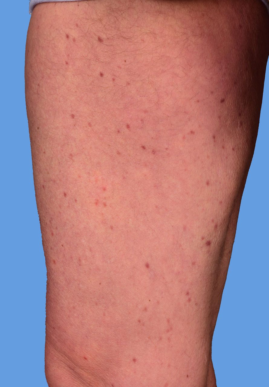 Interdisziplinäres Allergie-Symposium des Bergischen Allergiezentrums