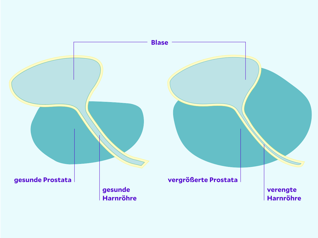 Grafik vergrößerte Prostata