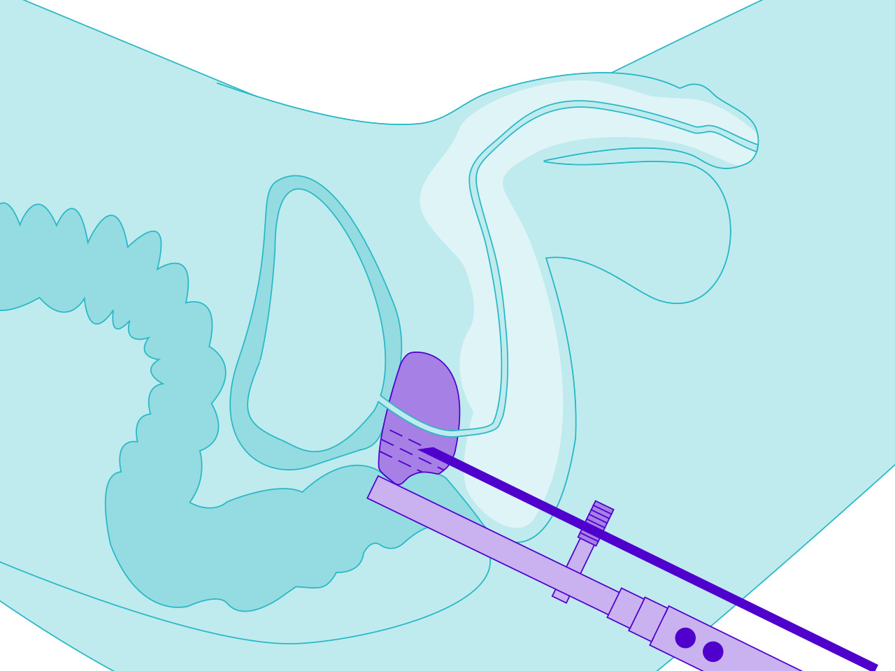 Brachytherapie: Bestrahlung von innen