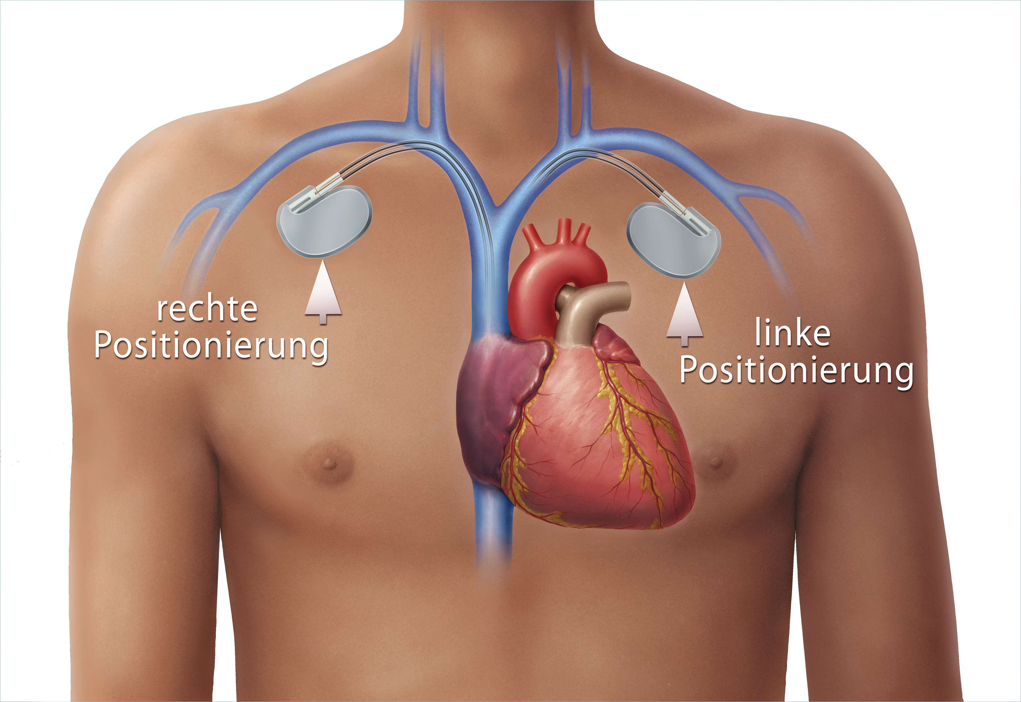 Herzschrittmacher Position im Körper