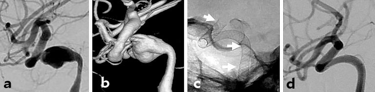Angiografie bzw. Röntgenaufnahme eines Flow Diverter-Stents.
