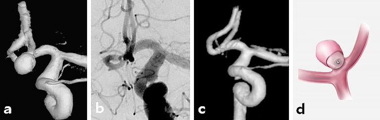 Angiografie bzw. Röntgenaufnahme eines Metallkörbchens zur Behandlung eines großen Aneurysmas.