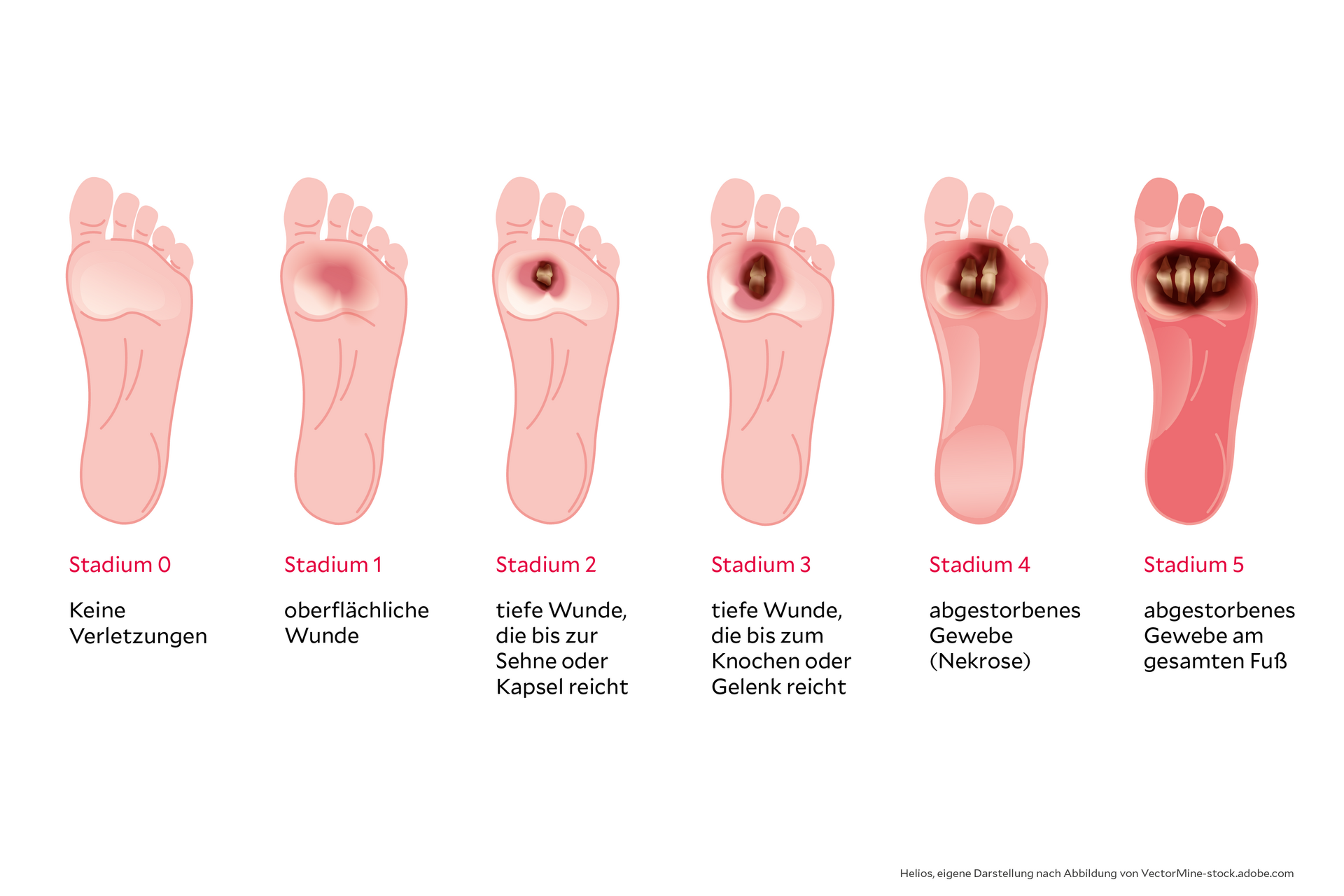 Illustration vom Diabetischen Fuß im Verlauf