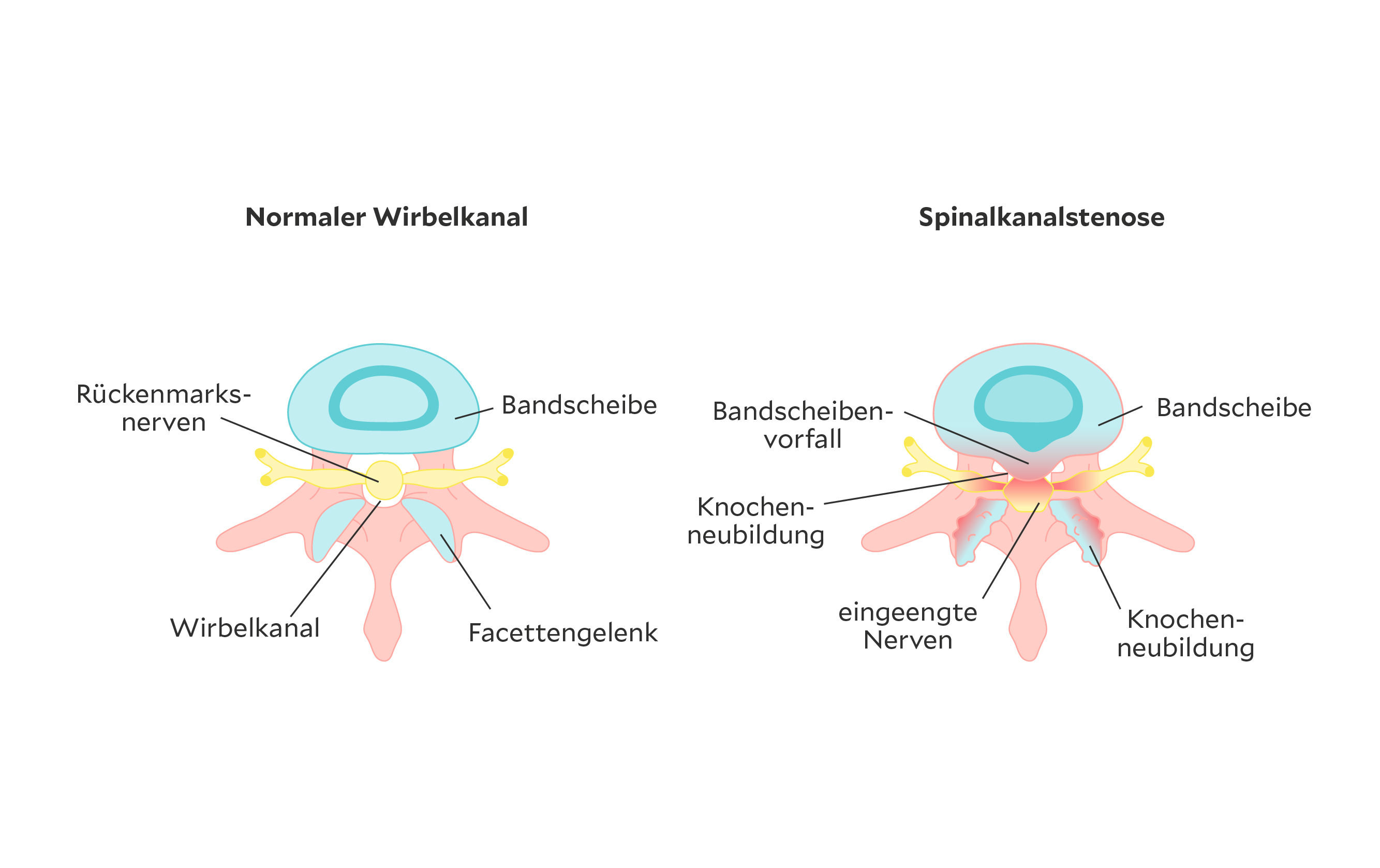Illustration Wirbelkanal normal versus Spinalkanalstenose