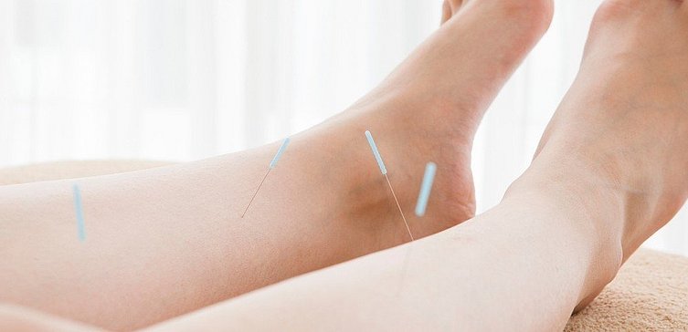 Frauenfüße mit Akupunkturnadeln