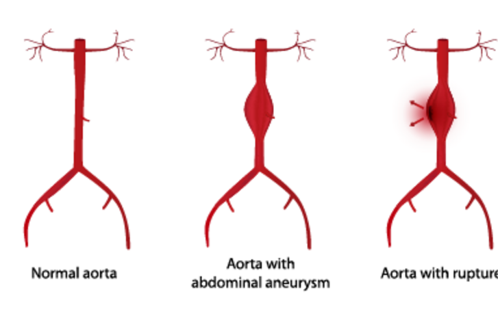 Entstehung eines Aneurysmas: I. Hauptschlagader im Normalzustand. II. Erweiterung der Aorta. Ursache dafür ist oft Arteriosklerose, also Ablagerungen an der Gefäßwand. An der Aussackung verwirbelt das Blut, es kommt zu Blutgerinseln. III. Die Gefäßwand wird dünner und droht schließlich zu zerreißen. Foto: ©bilderzwerg/fotolia.
