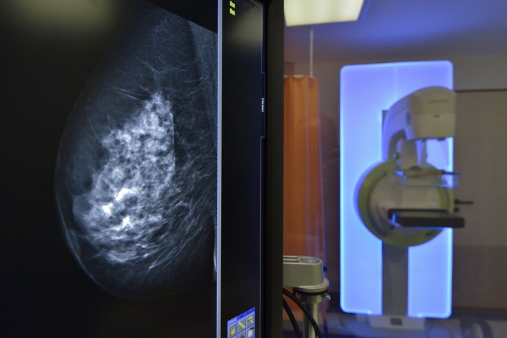 Mammographie – schonende Untersuchung der Brust
