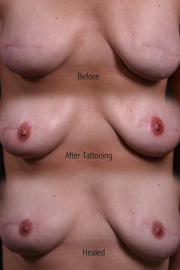 Weibliche Brust im Vergleich Vorher/Nachher