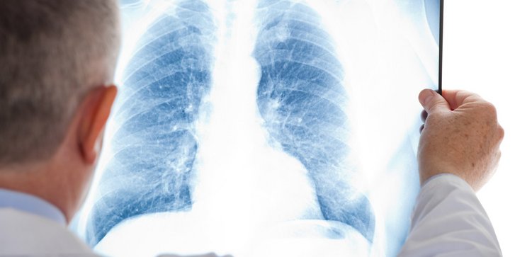Lunge Röntgenaufnahme