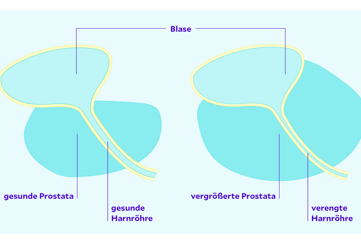 Grafische Darstellung normale vs. vergrößerte Prostata