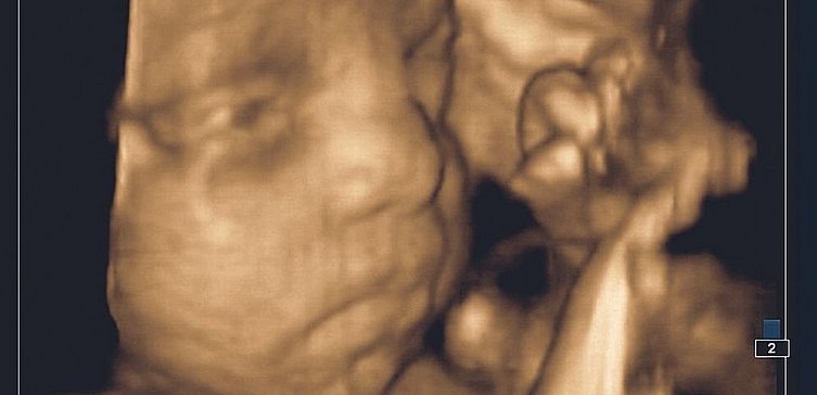 3D-Ultraschall Kind im Bauch
