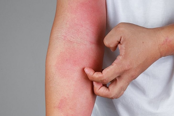 Atopische Dermatitis am Arm