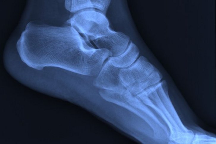 Auf gesunden Füßen: Fußchirurgie am HKD