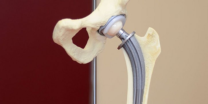Hüftknochenmodell mit implantierter Kurzschaftprothese CFP