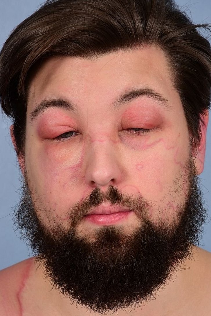 Mann mit Nesselsucht und geschwollenen Augen