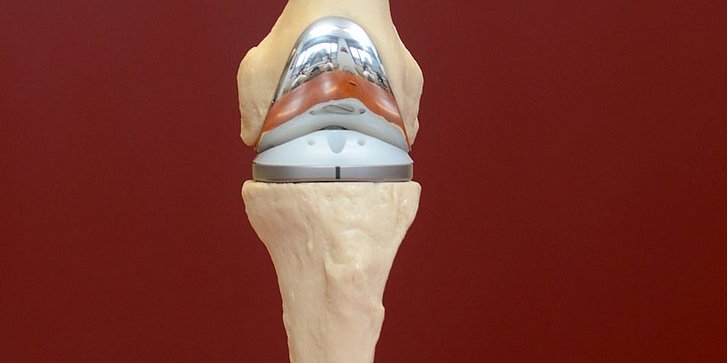 Knochenmodell mit implantierter Roknep Knieprothese