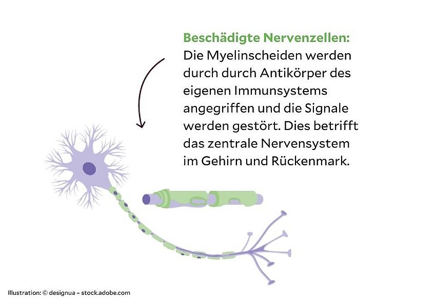 Illustration beschädigte Nervenzelle MS