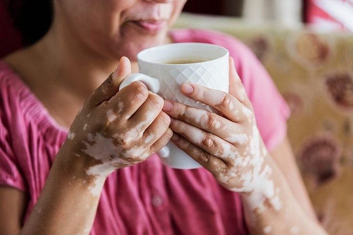 Frau mit Vitiligo trinkt Tee