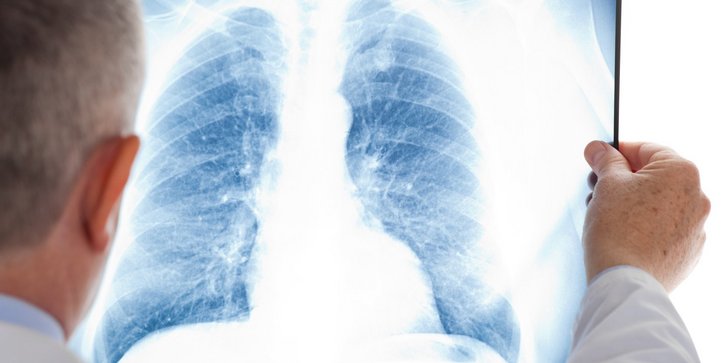 Image Röntgenaufnahme Lunge