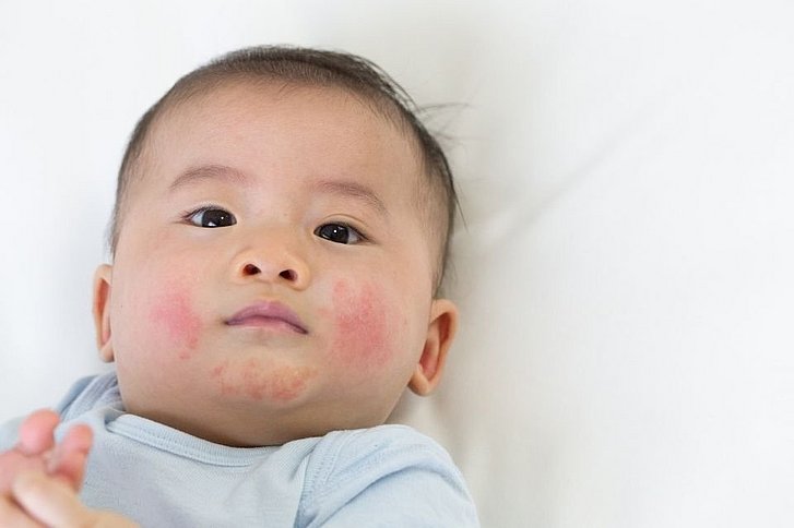 Asiatisches Baby mit Neurodermitis