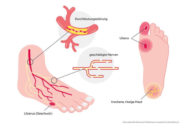 Illustration von einem diabetischen Fuß 