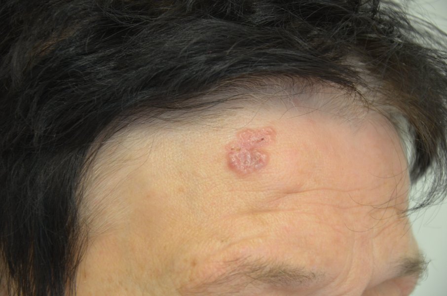 Weißer hautkrebs heilungschancen Hautkrebs behandeln:
