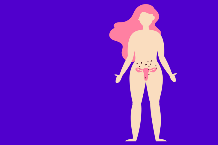 Endometriose: Erkennen und behandeln