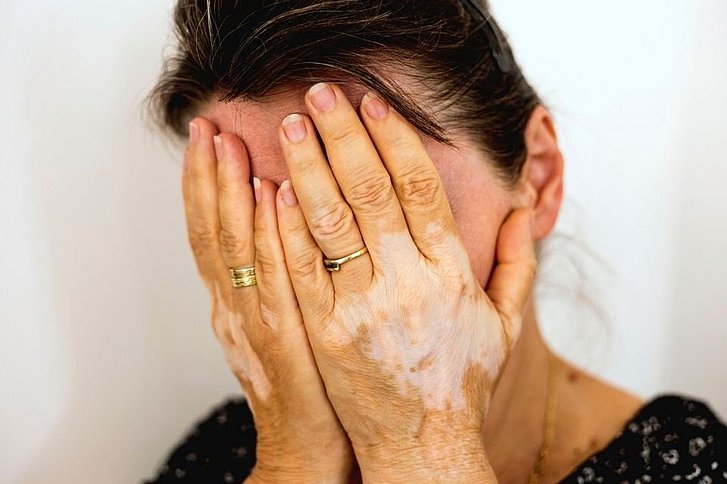 Frau hält sich Hände mit weißen Flecken vors Gesicht