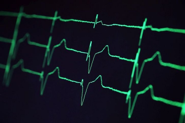 Wenn das Herz aus dem Takt gerät: Herzrhythmusstörungen