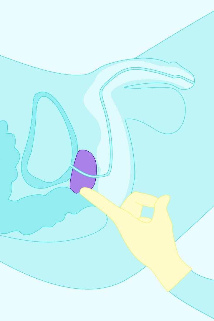 Grafische Darstellung Tastuntersuchung bei  Verdacht auf Prostatakrebs