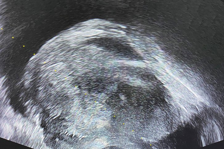 Ultraschall-gesteuerte Stanzbiopsie der Prostata