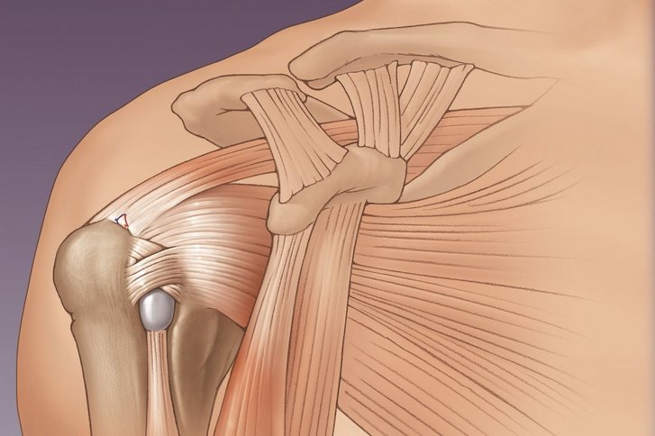 Schulterchirurgie: Expertise für Beschwerden an der Schulter